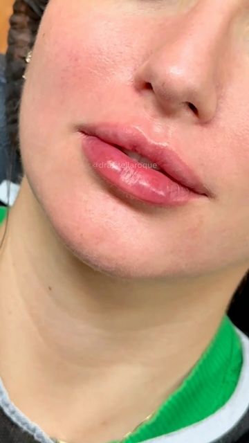 Criativo da Hazzon: Preenchimento labial