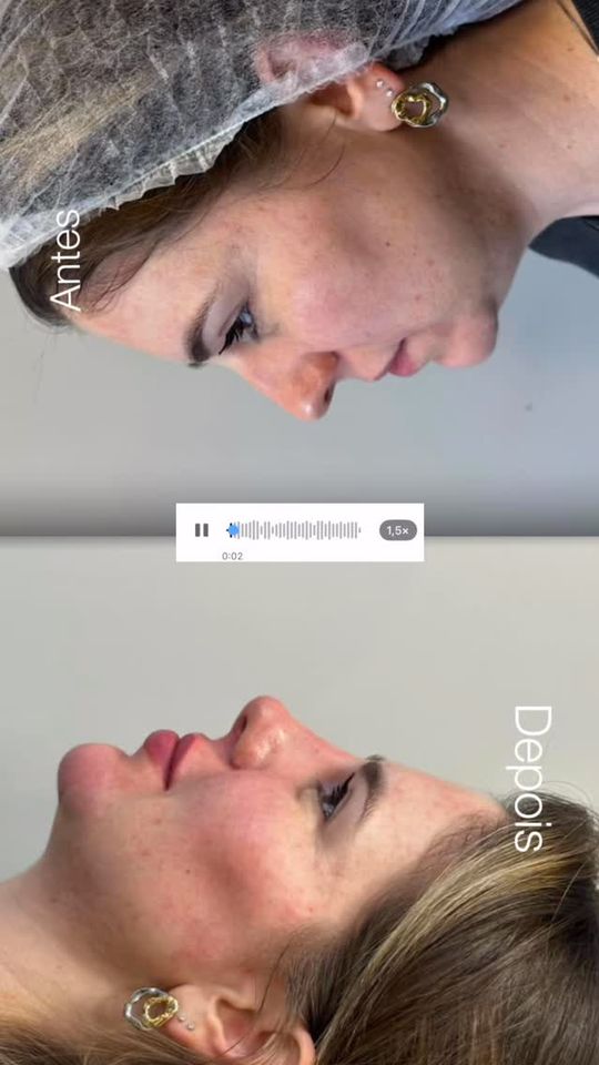 Antes e depois da harmonização
