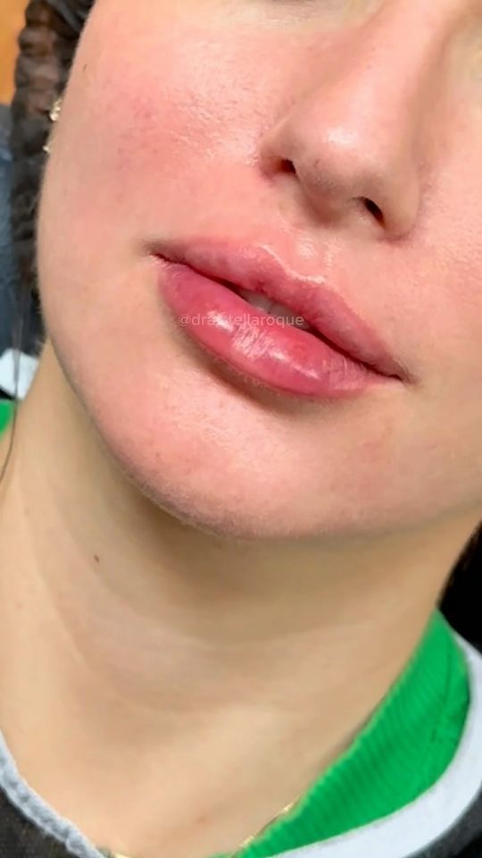 Preenchimento labial