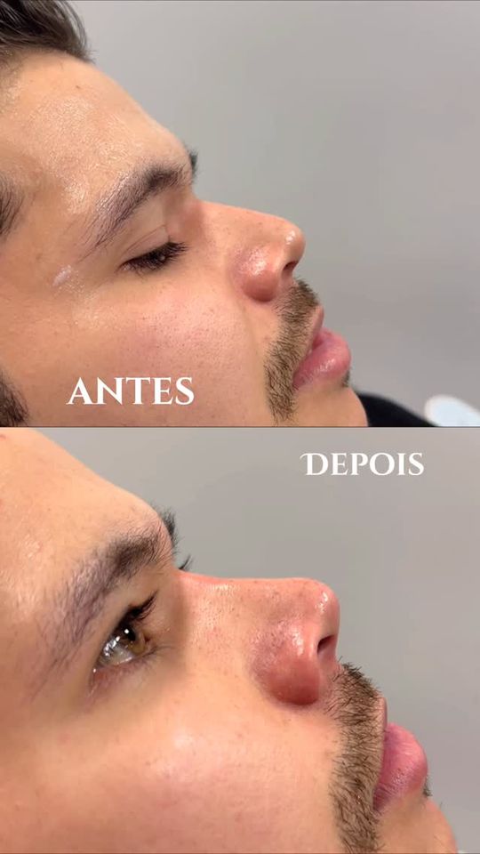 Rinomodelação, antes e depois